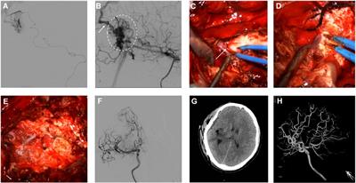 Hybrid surgery for coexistence of cerebral arteriovenous malformation and primitive trigeminal artery: A case report and literature review